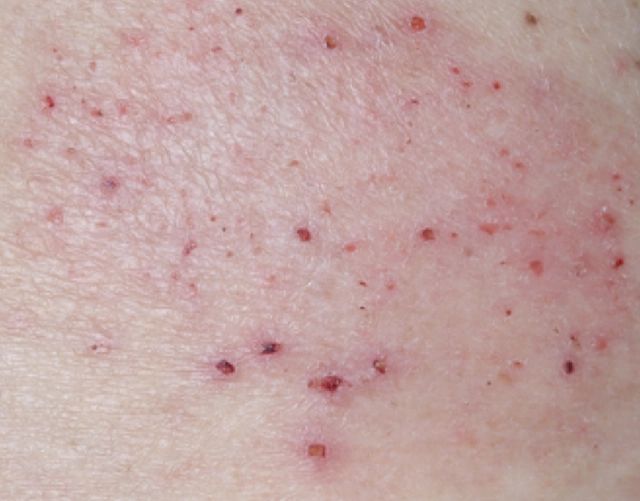 Patient with red, irritated skin and eczema patches before OPZELURA treatment