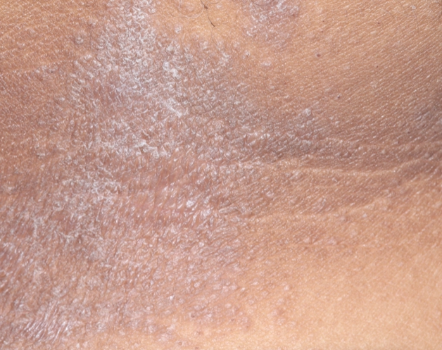 Patient before OPZELURA treatment with irritated and inflamed skin that is appearing as a bluish hue