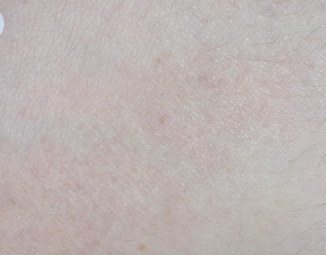 Patient with clearer skin, with less eczema after OPZELURA treatment