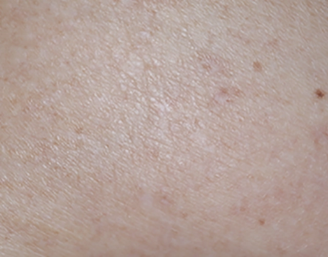 Patient with clearer skin, with less eczema after OPZELURA treatment