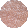 Click to see the 2nd patient's results after 8 weeks of treatment with OPZELURA