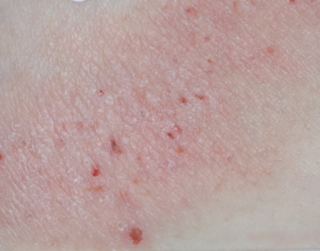 Patient with red, irritated skin and eczema patches before OPZELURA treatment