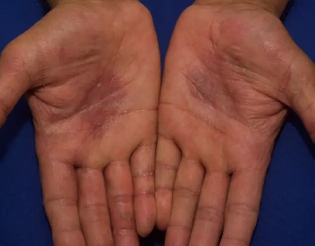 Patient with irritated skin and eczema patches before OPZELURA treatment