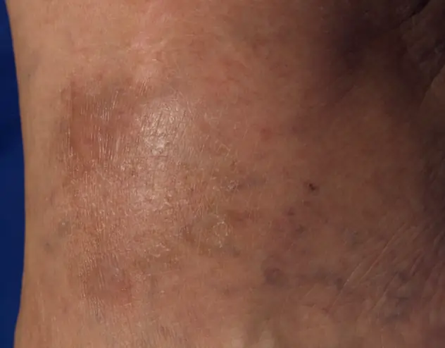 Patient with clearer skin, with less eczema after OPZELURA treatment