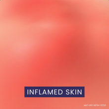 Part 2 of the Eczema Mechanism of Action video