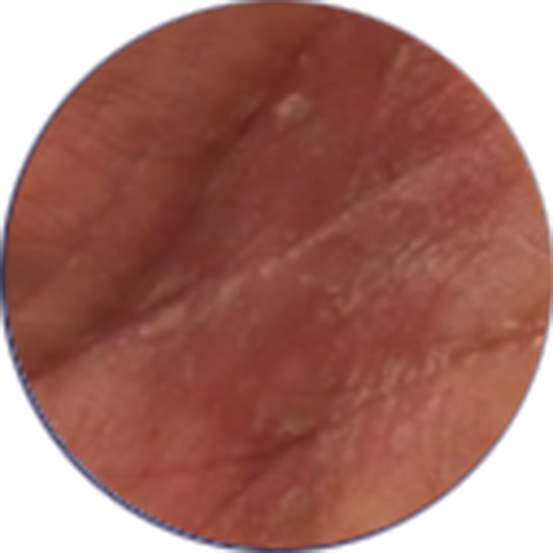 Click to see the results after 2 weeks of treatment with OPZELURA for a 67 year old patient