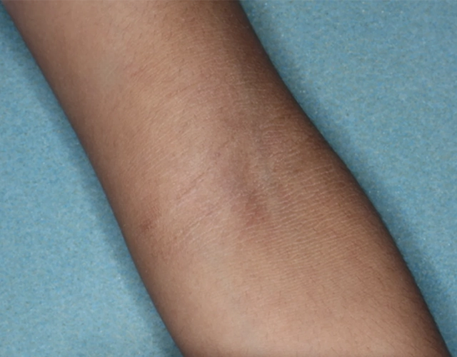 Patient 5 years old with clearer skin, with less eczema after OPZELURA treatment