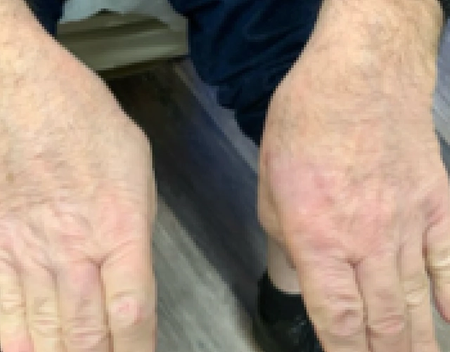 Patient 69 years old with clearer skin, with less eczema after OPZELURA treatment