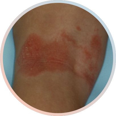 Clinical trial patient image, 2 year old, back of the knee, before treatment with OPZELURA