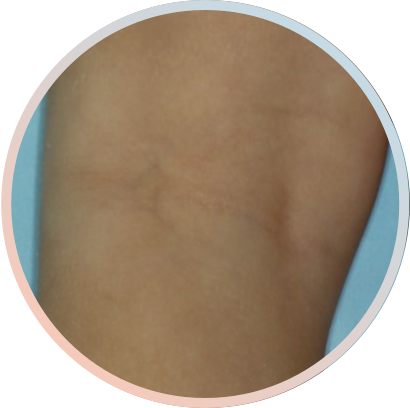 Clinical trial patient image, 2 year old, back of the knee, after 8 weeks of treatment with OPZELURA