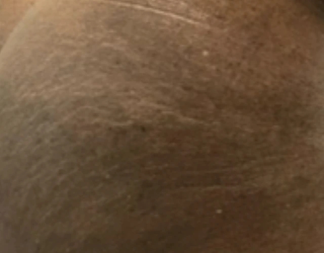 Patient 64 years old with clearer skin, with less eczema after OPZELURA treatment