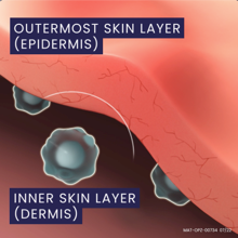 Part 4 of the Eczema Mechanism of Action video