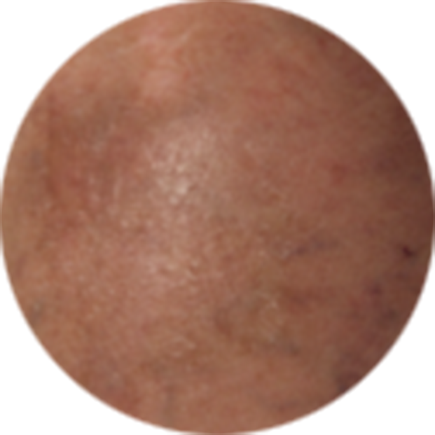 Click to see the results after 2 weeks of treatment with OPZELURA for a 75 year old patient