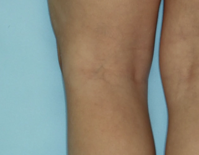 Patient 2 years old with clearer skin, with less eczema after OPZELURA treatment