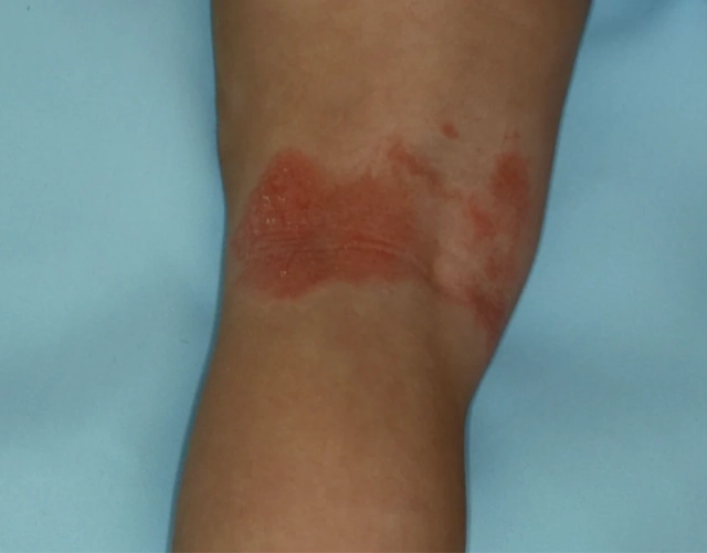 Patient 2 years old with irritated skin and eczema patches before OPZELURA treatment