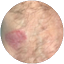 Click to see the results after 5 weeks of treatment with OPZELURA for a 69 year old patient
