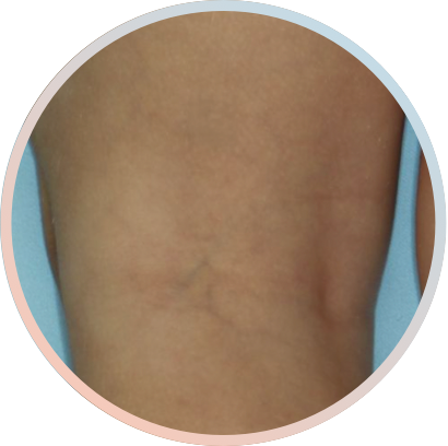 Clinical trial patient image, 2 year old, back of the knee, after 2 weeks of treatment with OPZELURA