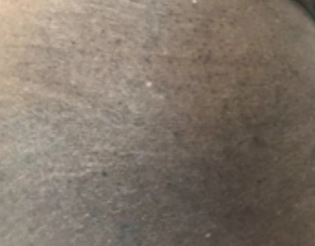 Patient 64 years old with irritated skin and eczema patches before OPZELURA treatment