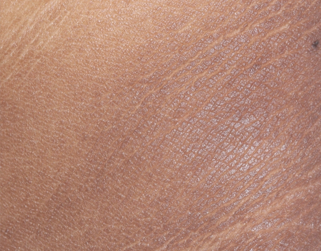 Patient 64 years old with clearer skin, with less irritation after OPZELURA treatment