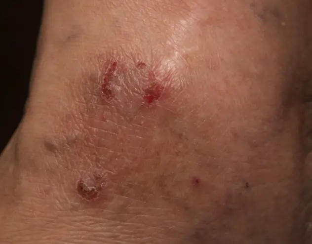 Patient 75 years old with irritated skin and eczema patches before OPZELURA treatment