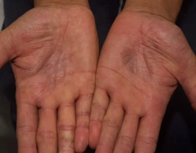 Patient 67 years old with clearer skin, with less eczema after OPZELURA treatment