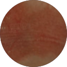 Click to see the results after 8 weeks of treatment with OPZELURA for a 2 year old patient