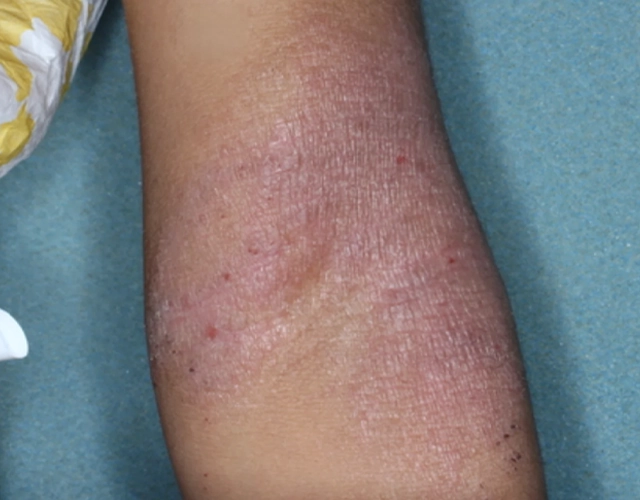 Patient 5 years old with irritated skin and eczema patches before OPZELURA treatment