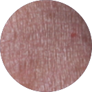 Click to see the results after 8 weeks of treatment with OPZELURA for a 5 year old patient