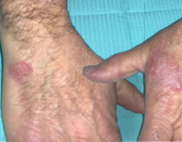 Patient 69 years old with irritated skin and eczema patches before OPZELURA treatment