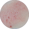 Click to see the results after 8 weeks of treatment with OPZELURA for an 85 year old patient