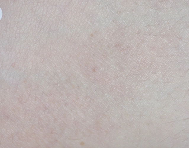 Patient 15 years old with clearer skin, with less eczema after OPZELURA treatment