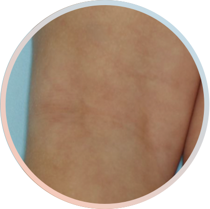 Clinical trial patient image, 2 year old, back of the knee, after 4 weeks of treatment with OPZELURA