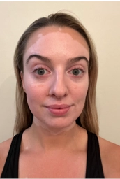 Front view of a young woman's face with vitiligo, showing depigmentation before treatment with OPZELURA.