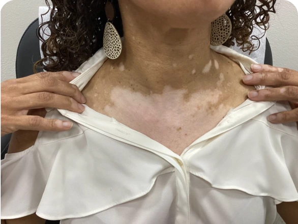 Patient's chest before treatment with OPZELURA, at baseline.