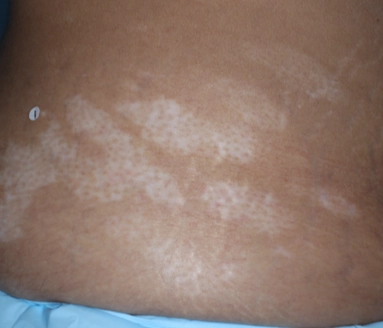 Patient's abdomen showing repigmentation progress after 6 months of treatment with OPZELURA.
