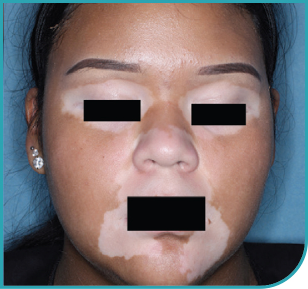 Female patient's face before treatment with OPZELURA