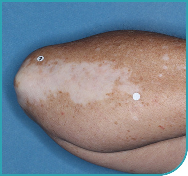 Patient's elbow before treatment with OPZELURA