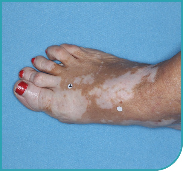 Patient's foot before treatment with OPZELURA