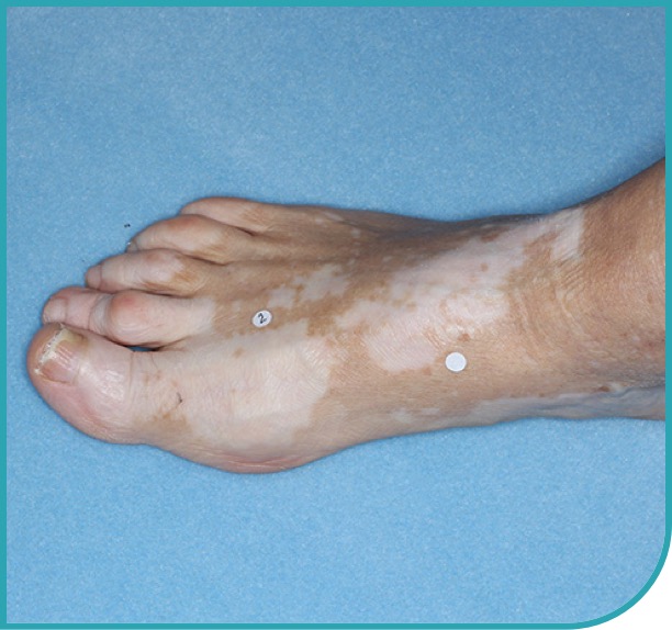 Patient's foot after 3 months of treatment with OPZELURA
