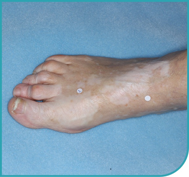 Patient's foot after 6 months of treatment with OPZELURA
