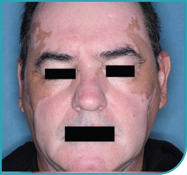 Male patient's face before treatment with OPZELURA