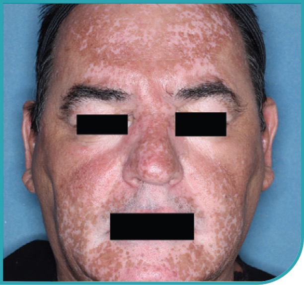 Male patient's face after 3 months of treatment with OPZELURA