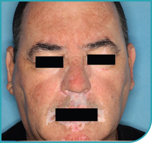 Male patient's face after 6 months of treatment with OPZELURA