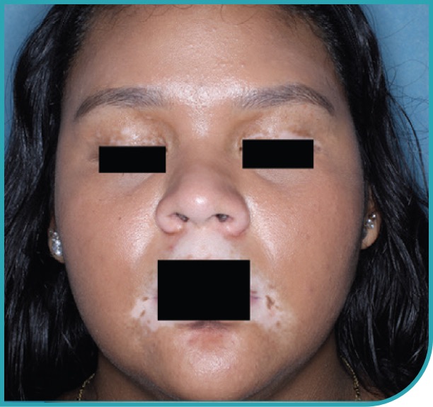 Female patient's face after 6 months of treatment with OPZELURA