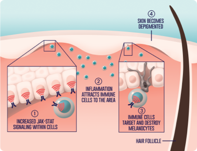 Increased JAK-stat signaling within cells causes inflamation which attracts immune cells to the area. Immune cells target and destroy melanocytes and skin becomes depigmented