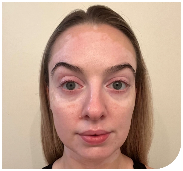 Female patient's face at 2 months of treatment with OPZELURA