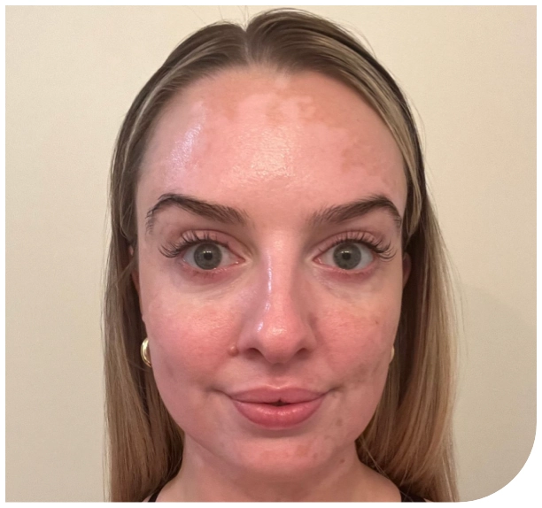 Female patient's face at 8 months of treatment with OPZELURA