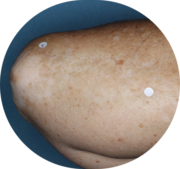 A patient's elbow and forearm showing repigmentation progress after 3 months of treatment.