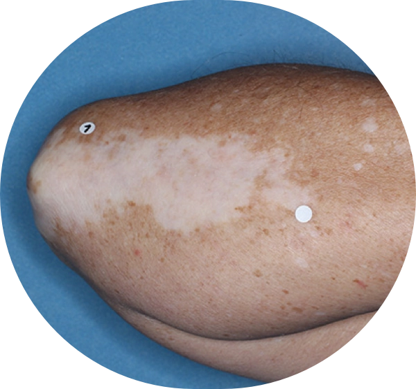 A vitiligo patient showing depigmentation across their elbow and forearm before treatment with OPZELURA.