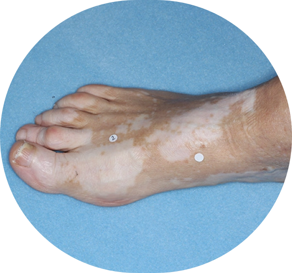 A patient's foot showing some repigmentation progress after 3 months of treatment.